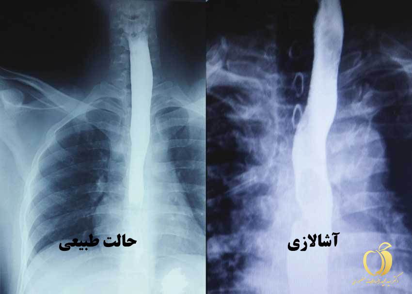 تفاوت مری طبیعی و سالم با آشالازی