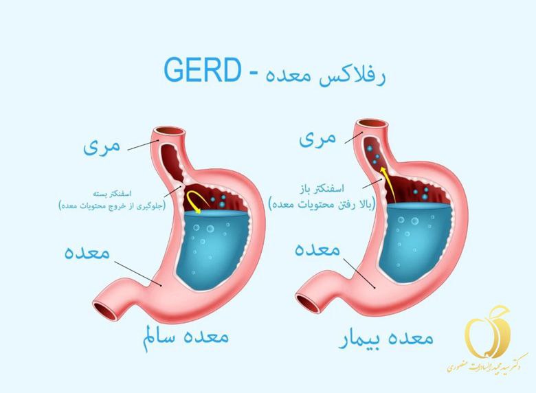 تفاوت دریچه معده سالم و دریچه معده در رفلاکس 