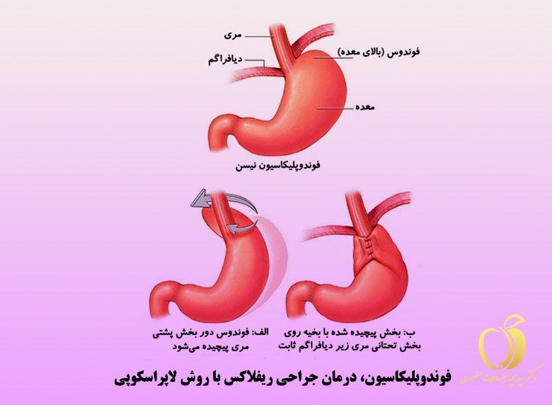 درمان رفلاکس معده با جراحی به روش لاپاراسکوپی