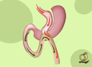 آیا ساسی بای پس معده کم خطرترین روش لاغری ممکن است؟