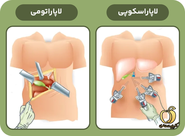 تفاوت لاپاراسکوپی و لاپاراتومی