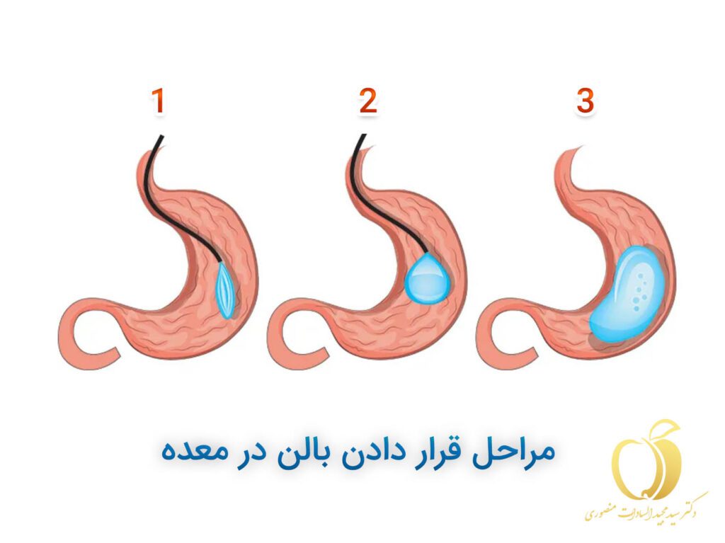 روش کار گذاشتن بالن