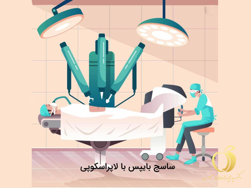 ساسج به روش لاپاراسکوپی