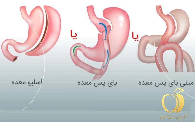 بهترین روش جراحی لاغری شکم