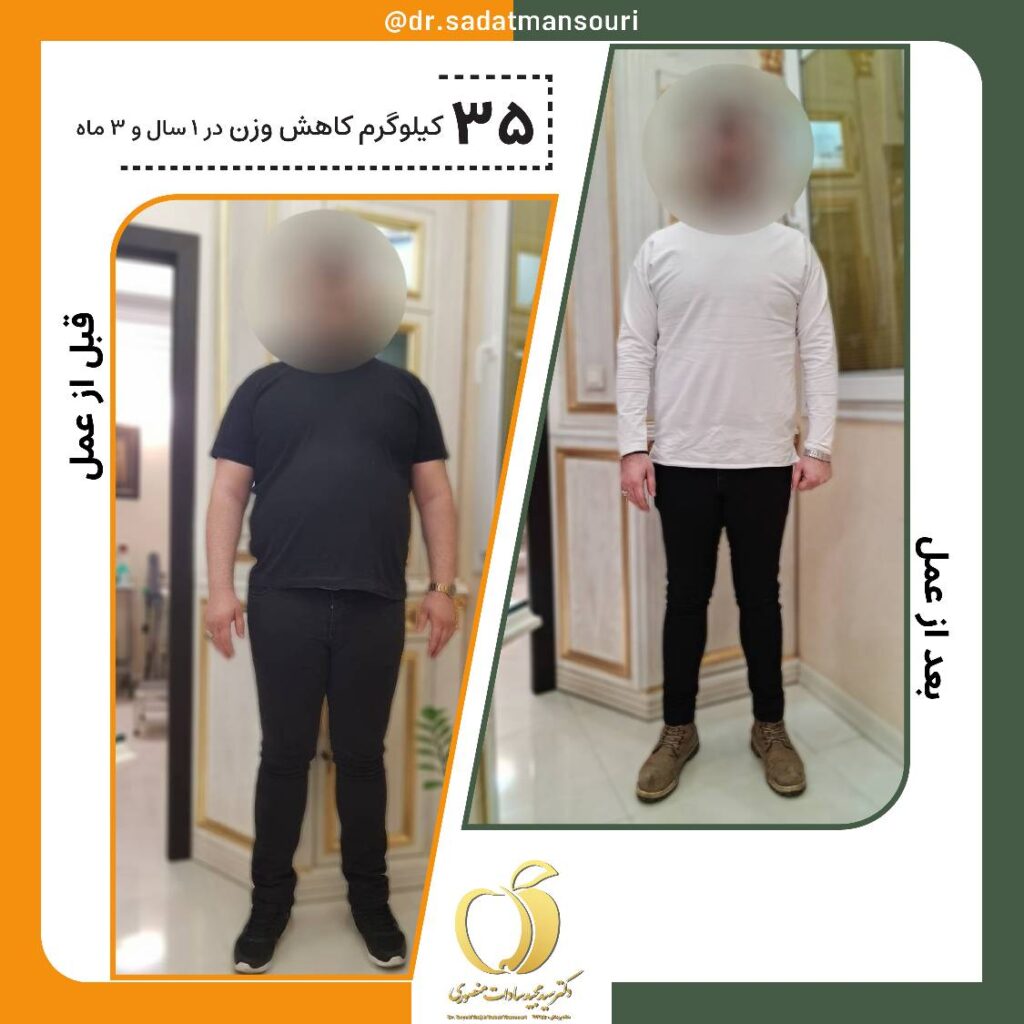 جراحی بای‌پس معده و کنترل اشتهای شبانه