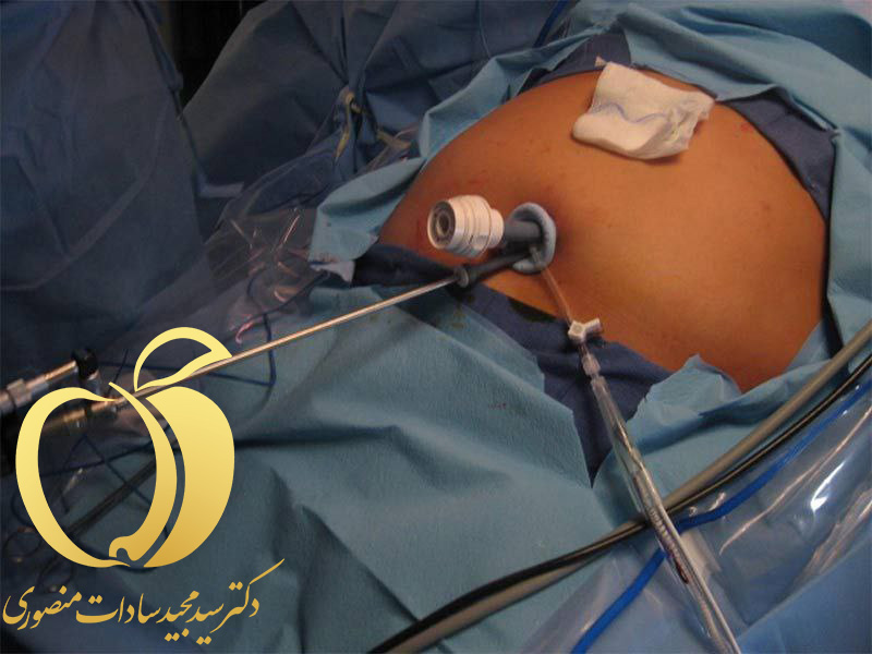 عمل های لاغری جدید