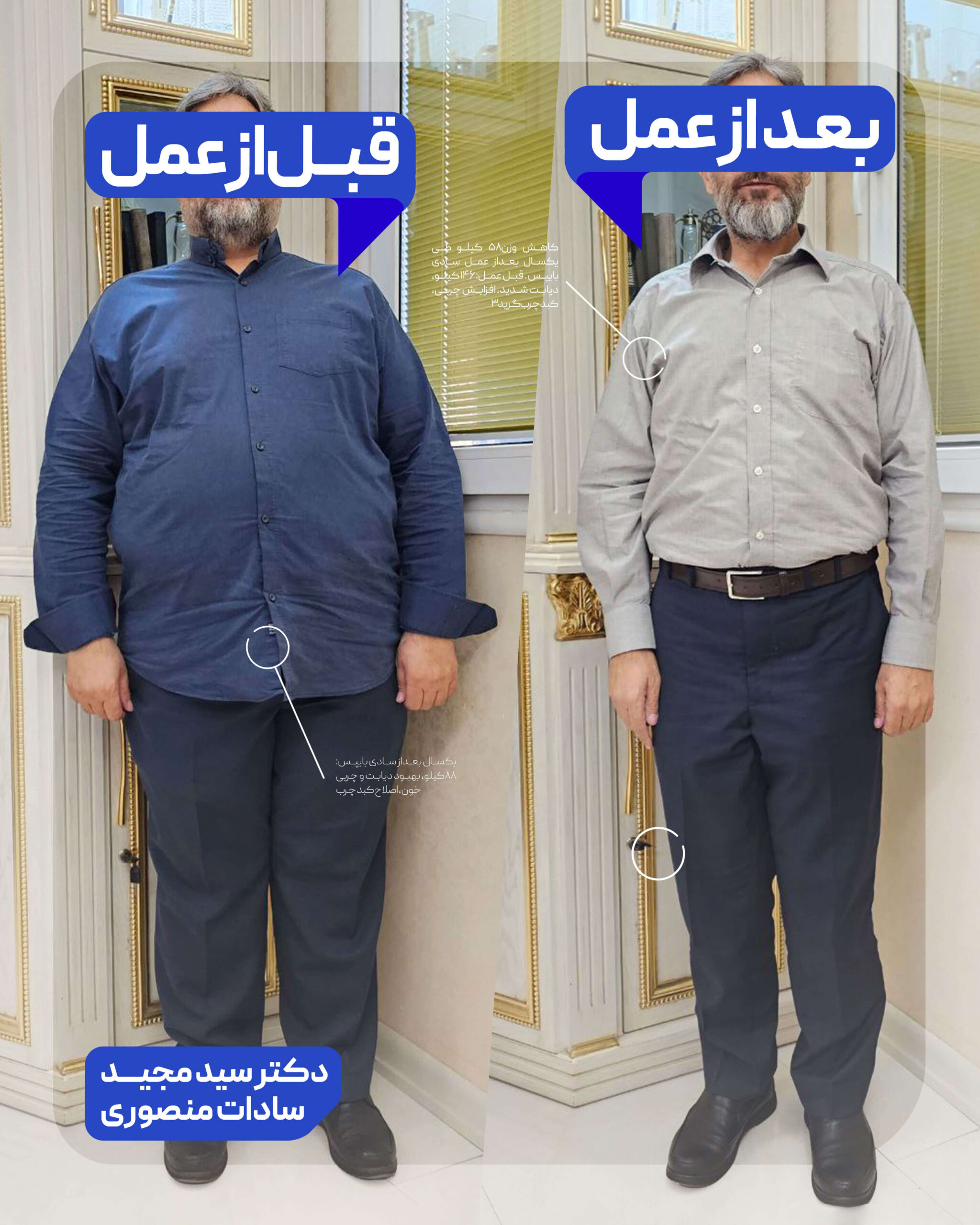 عمل جراحی چاقی