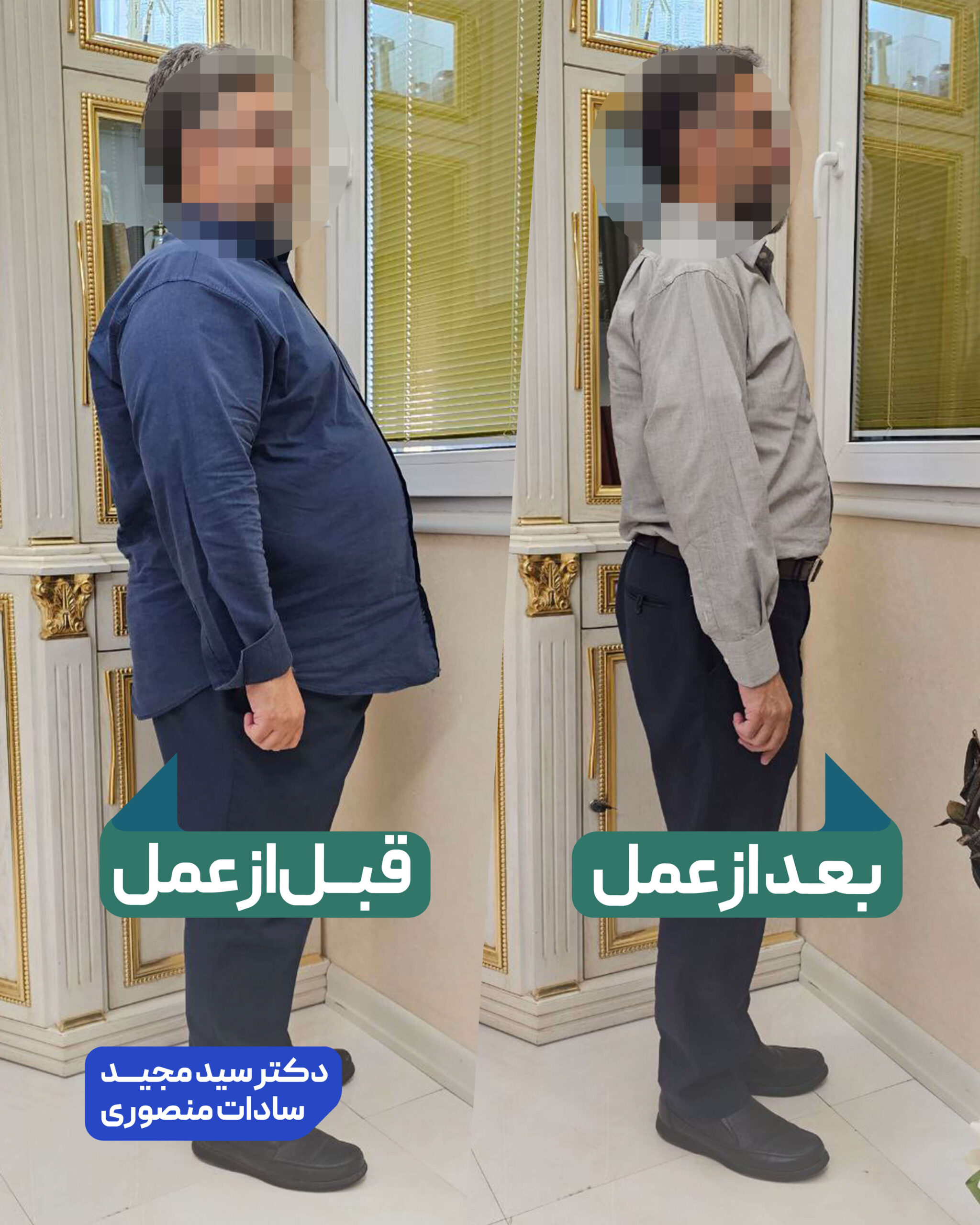 عمل جراحی چاقی
