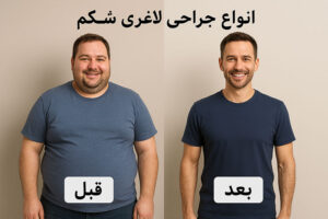 انواع جراحی لاغری شکم